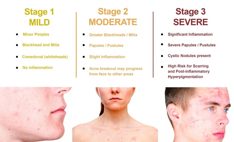 acne-signs-and-symptoms-yarm-k7yg4fol